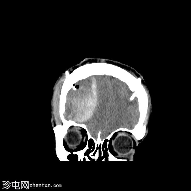 分流术后亚急性硬膜外血肿