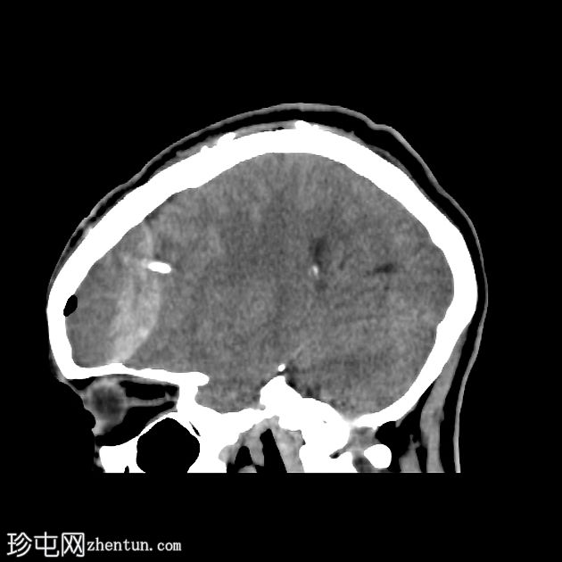 分流术后亚急性硬膜外血肿