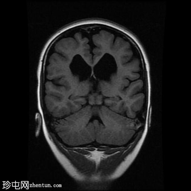 脑室周围白质软化