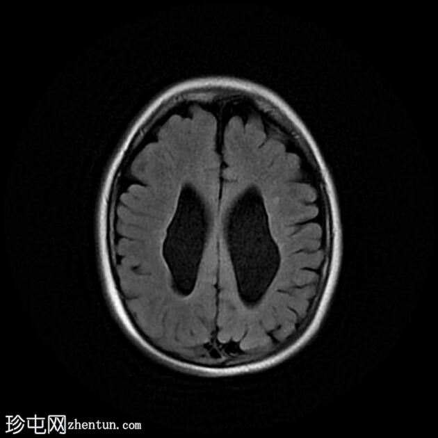 脑室周围白质软化