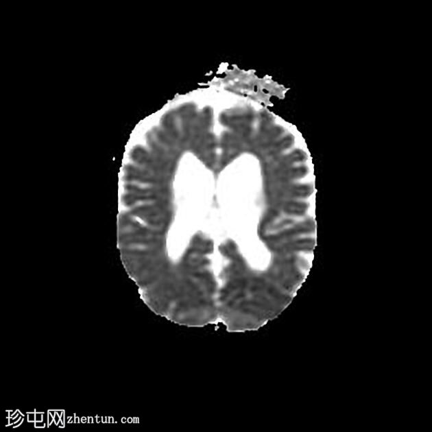 脑室周围白质软化