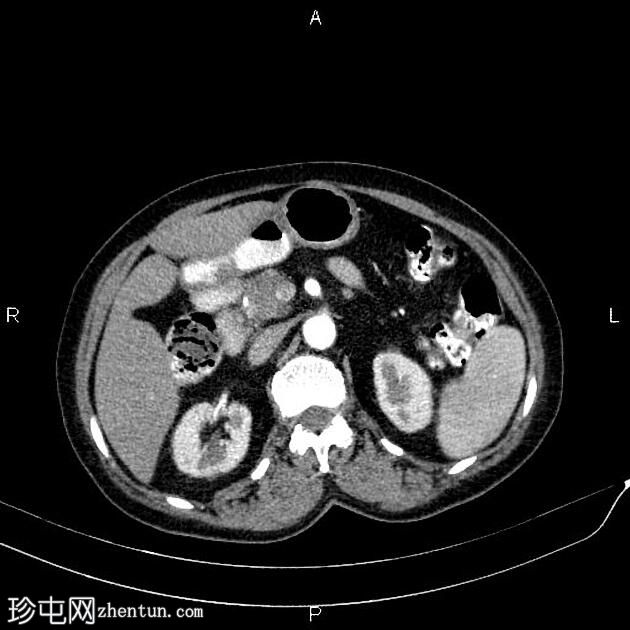 胰腺导管腺癌 - 可切除