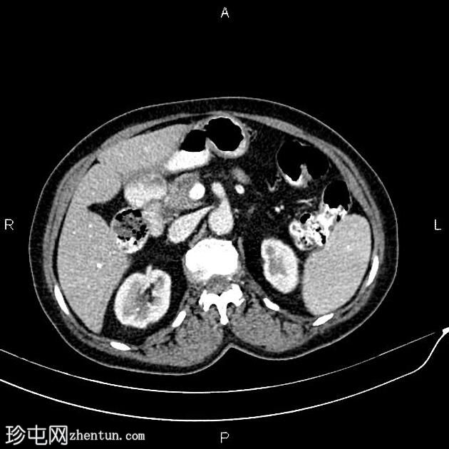 胰腺导管腺癌 - 可切除