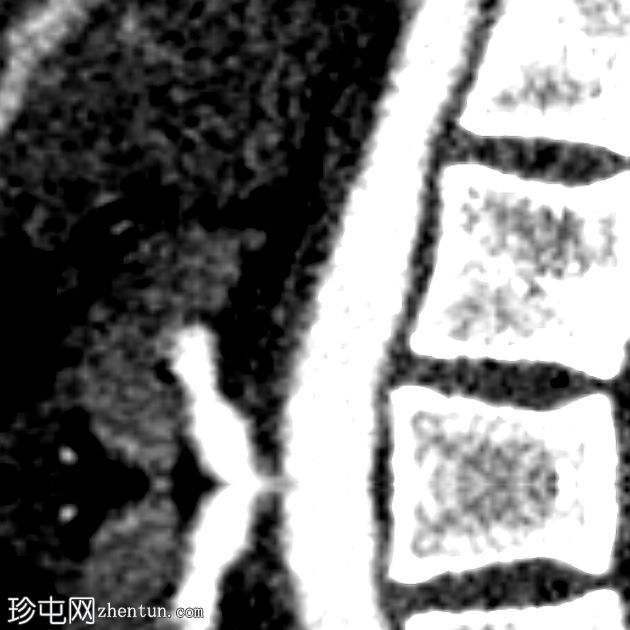 腹腔动脉受压综合征