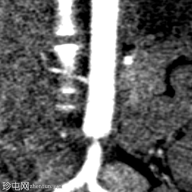 腹腔动脉受压综合征