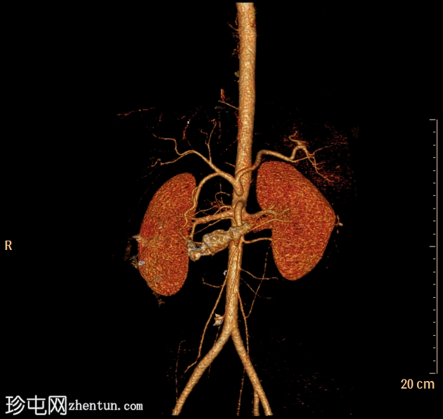 腹腔动脉受压综合征