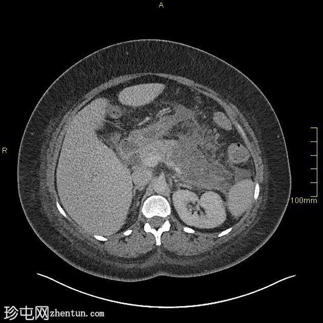 坏死性胰腺炎