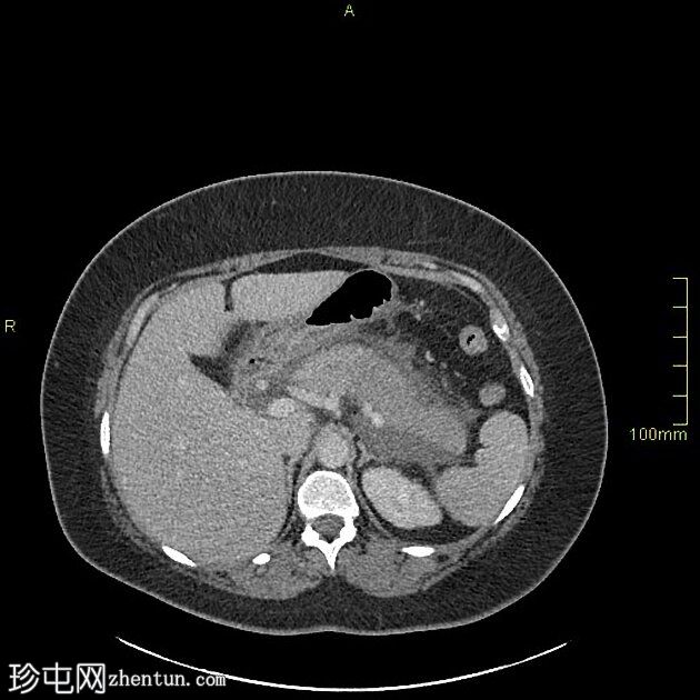 坏死性胰腺炎