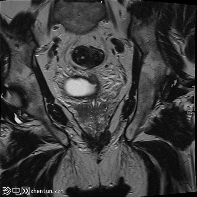 同时发生的膀胱和前列腺恶性肿瘤