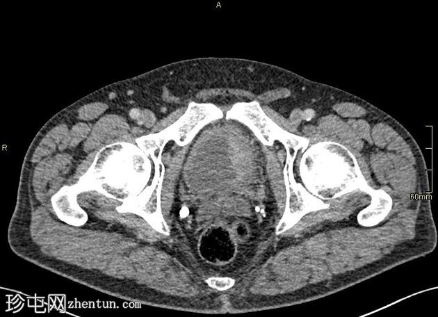 同时发生的膀胱和前列腺恶性肿瘤