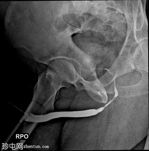 球尿道狭窄和静脉内渗出