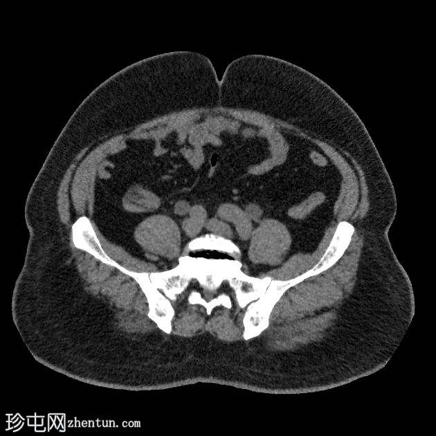 肾结石、输尿管结石和膀胱结石