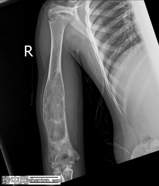 纤维发育不良 - 肱骨