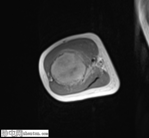 纤维发育不良 - 肱骨