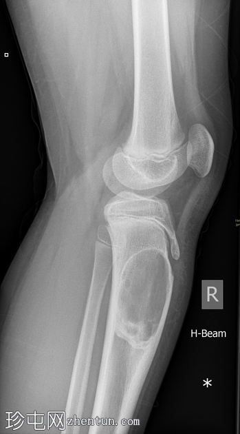 动脉瘤性骨囊肿 - 胫骨