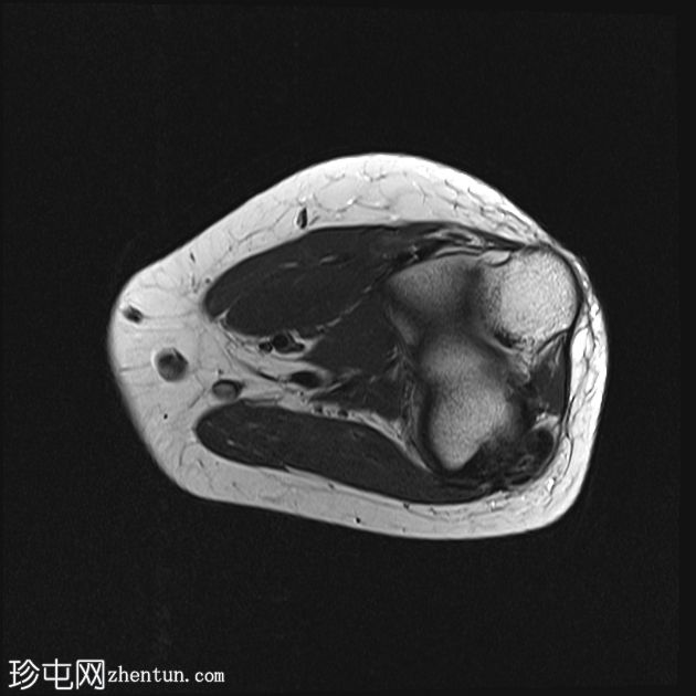 急性钙化性关节周围炎