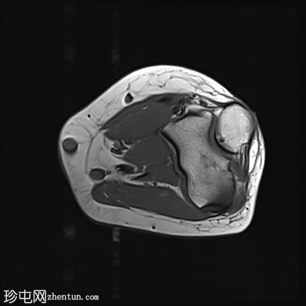 急性钙化性关节周围炎