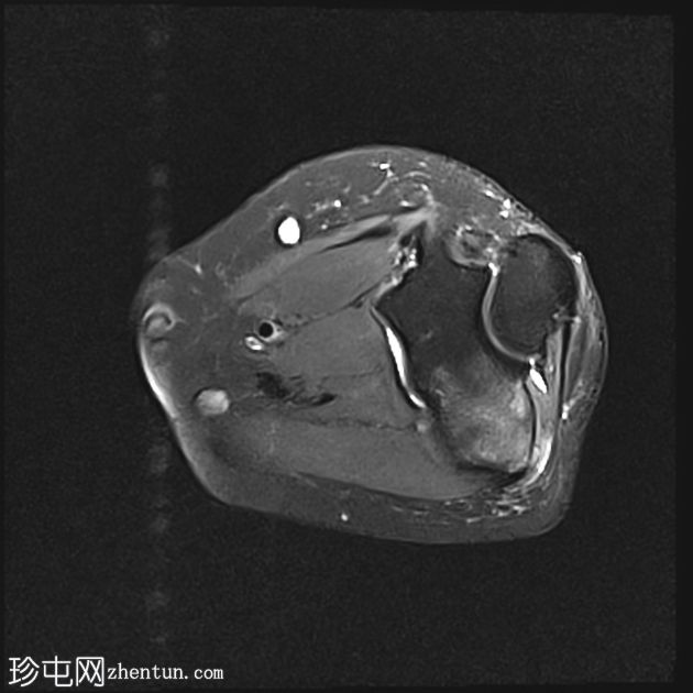 急性钙化性关节周围炎