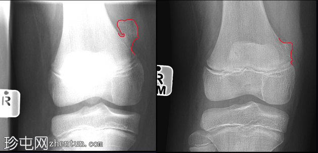 骨软骨瘤-青少年生长