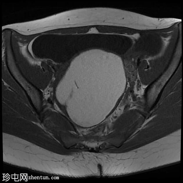 大型卵巢子宫内膜异位症伴有 T2 黑点征