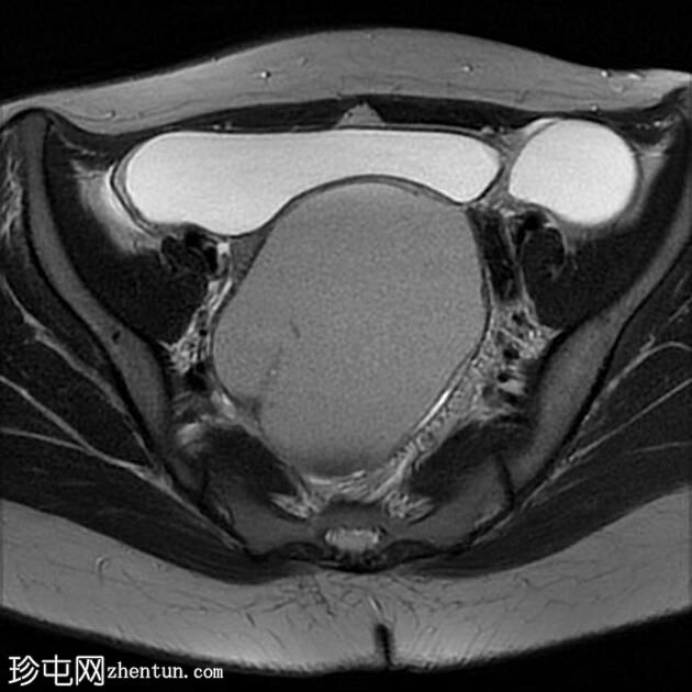 大型卵巢子宫内膜异位症伴有 T2 黑点征