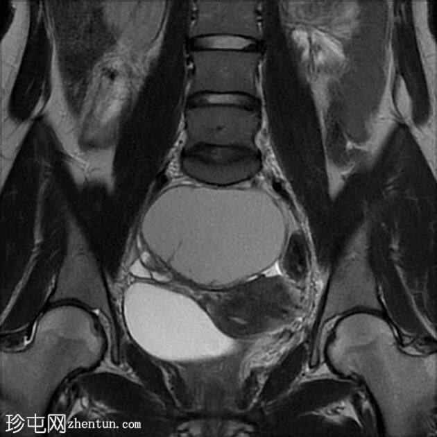 大型卵巢子宫内膜异位症伴有 T2 黑点征