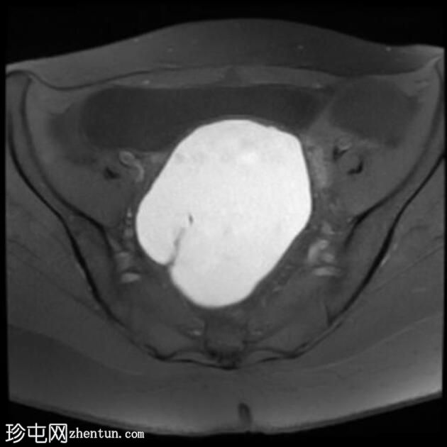 大型卵巢子宫内膜异位症伴有 T2 黑点征
