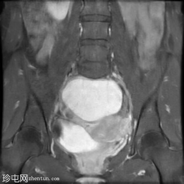 大型卵巢子宫内膜异位症伴有 T2 黑点征