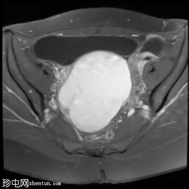 大型卵巢子宫内膜异位症伴有 T2 黑点征