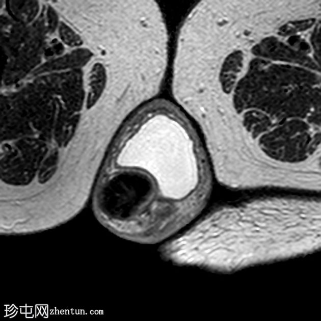 多部位盆腔器官脱垂