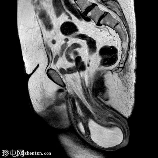 多部位盆腔器官脱垂