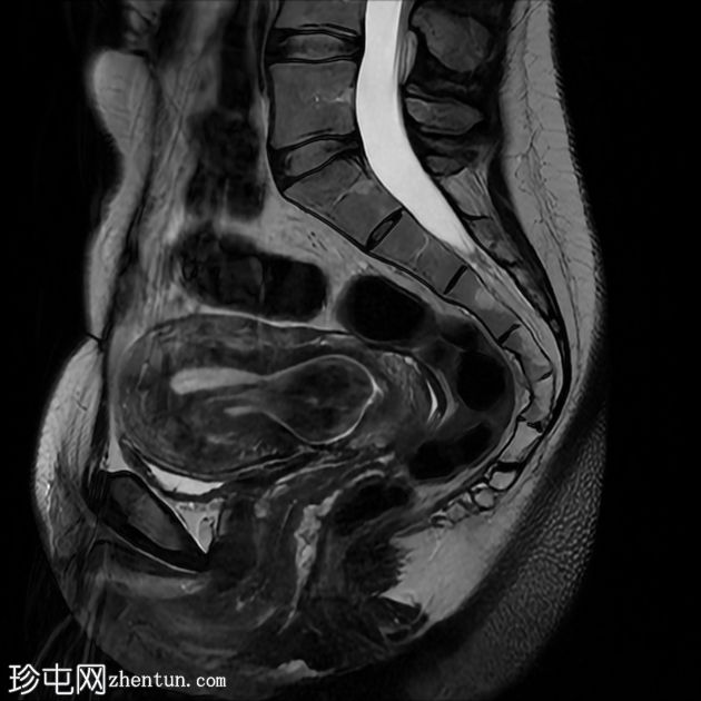 腔内子宫肌瘤