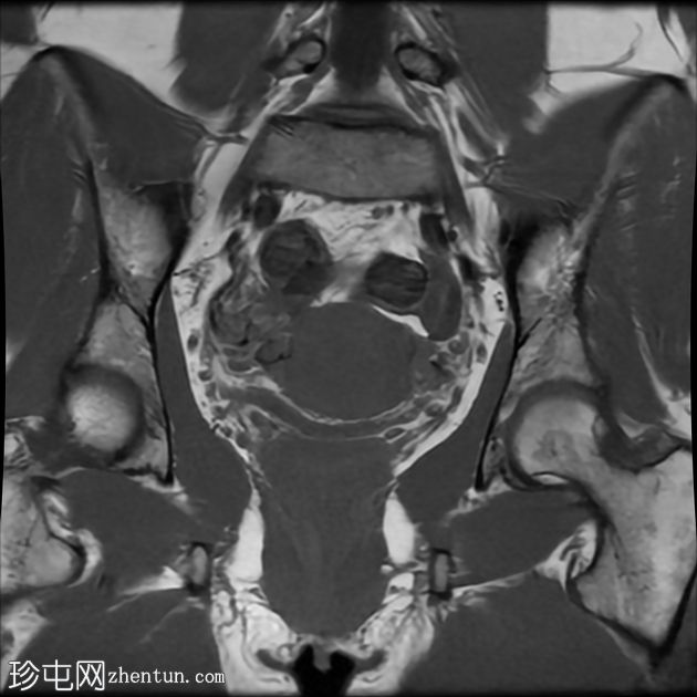 腔内子宫肌瘤