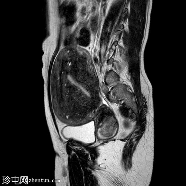 弥漫性子宫腺肌病伴有宫颈息肉