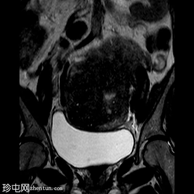 弥漫性子宫腺肌病伴有宫颈息肉