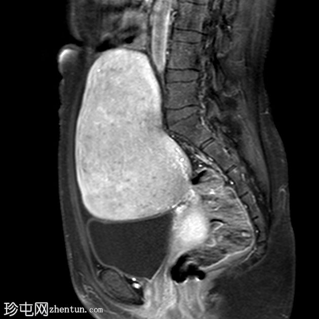 弥漫性子宫腺肌病伴有宫颈息肉