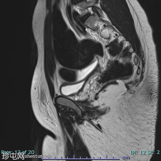 雄激素不敏感综合征