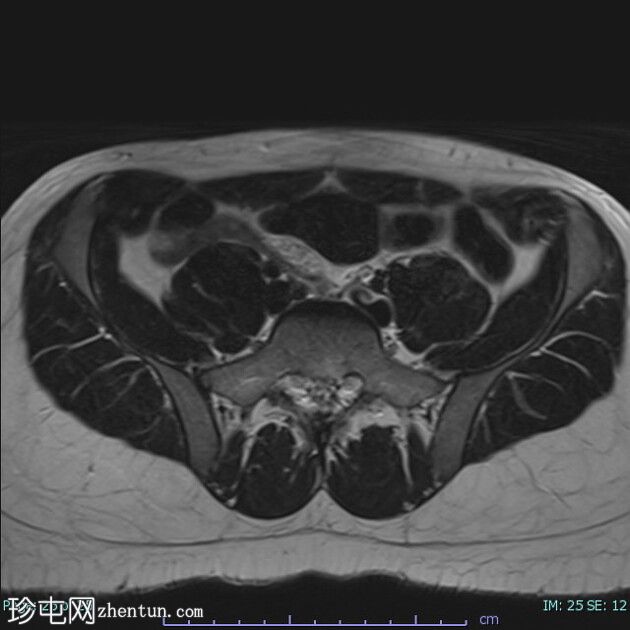 雄激素不敏感综合征