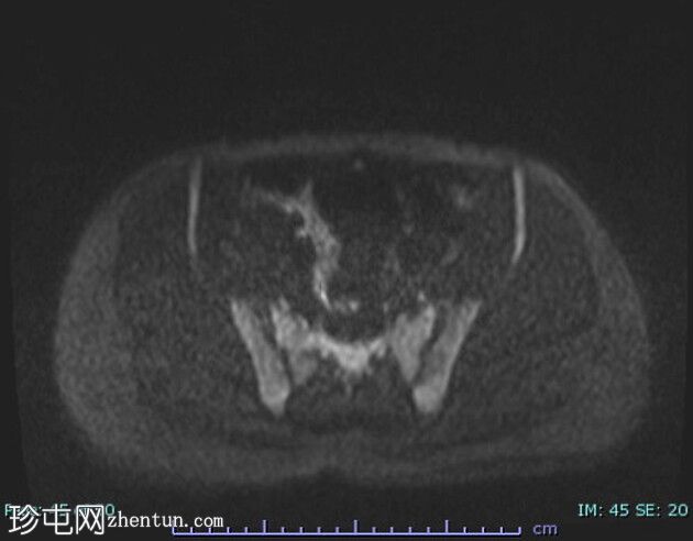 雄激素不敏感综合征