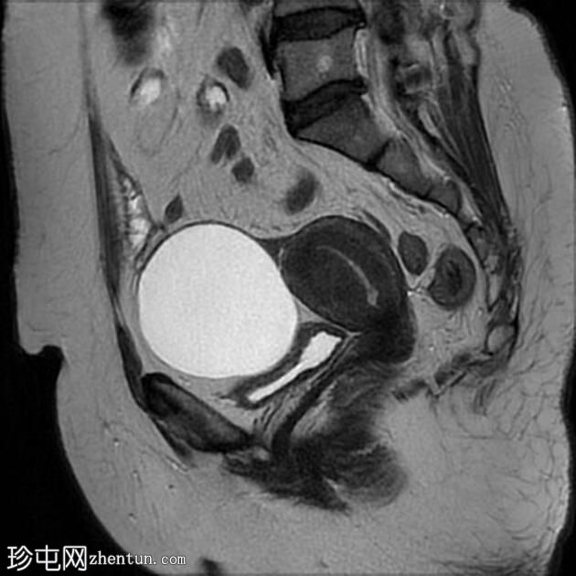 卵巢浆液性包涵囊肿