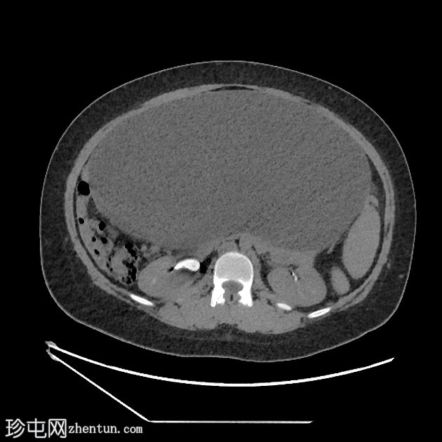 卵巢浆液性囊腺瘤