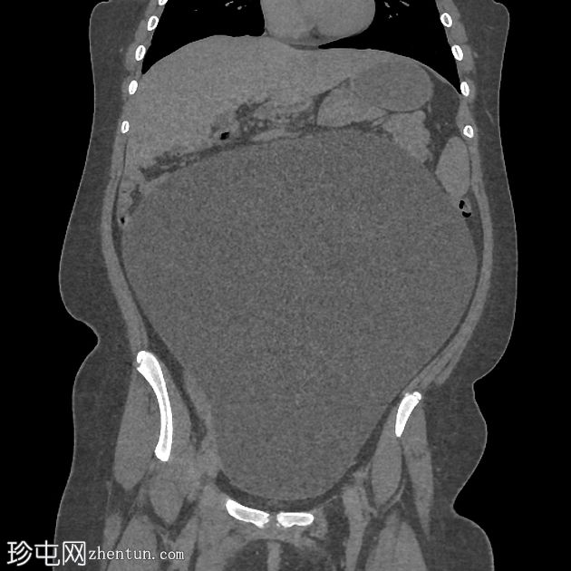 卵巢浆液性囊腺瘤