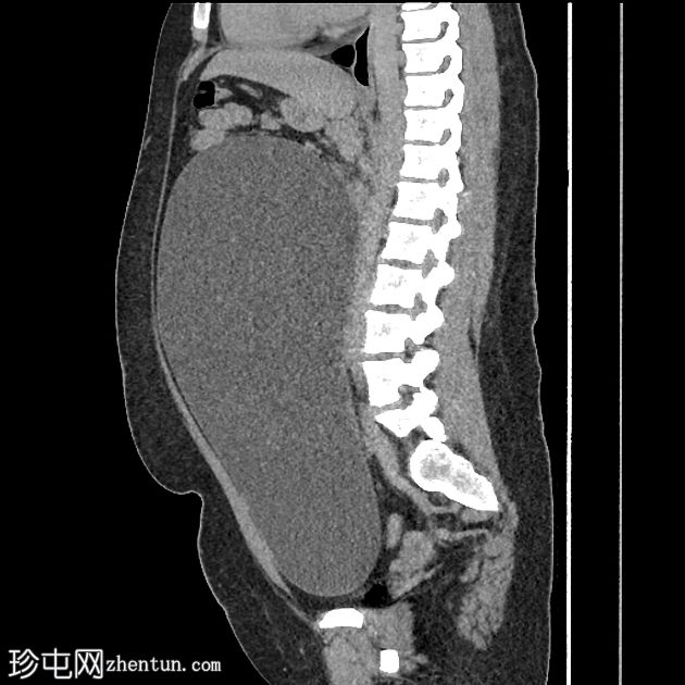 卵巢浆液性囊腺瘤