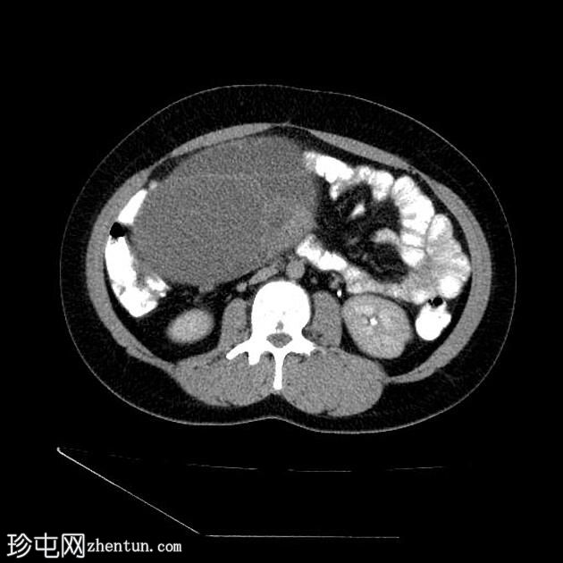 浆液性卵巢囊腺癌