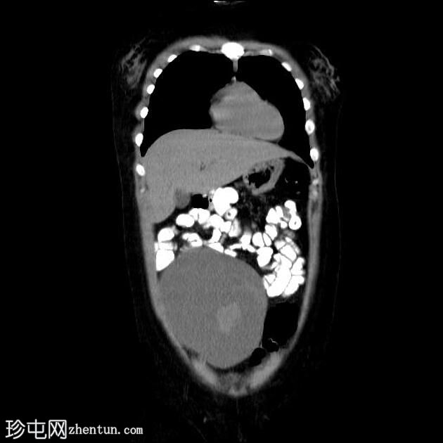 浆液性卵巢囊腺癌