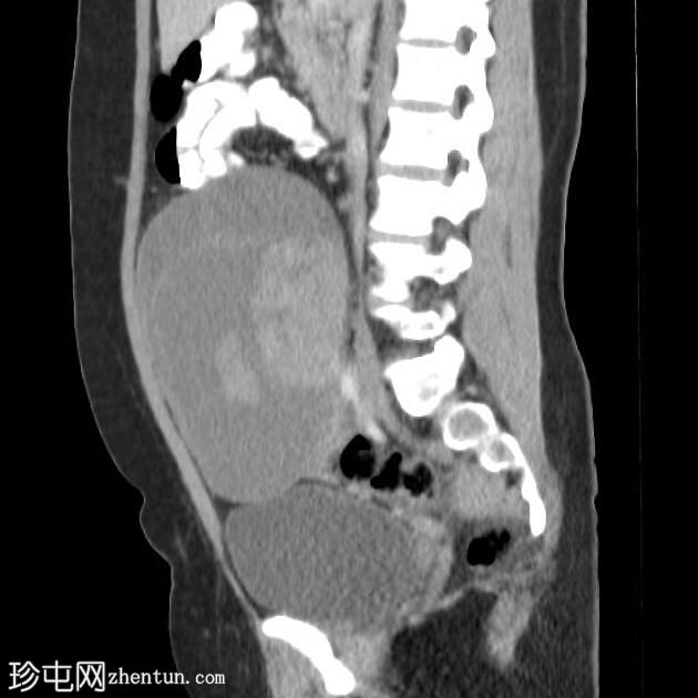 浆液性卵巢囊腺癌