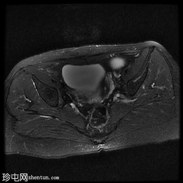 输卵管积水（MRI）