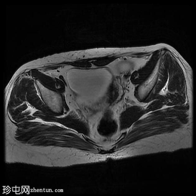 输卵管积水（MRI）