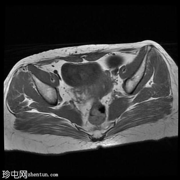 输卵管积水（MRI）