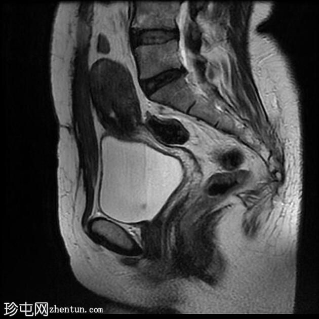 输卵管积水（MRI）